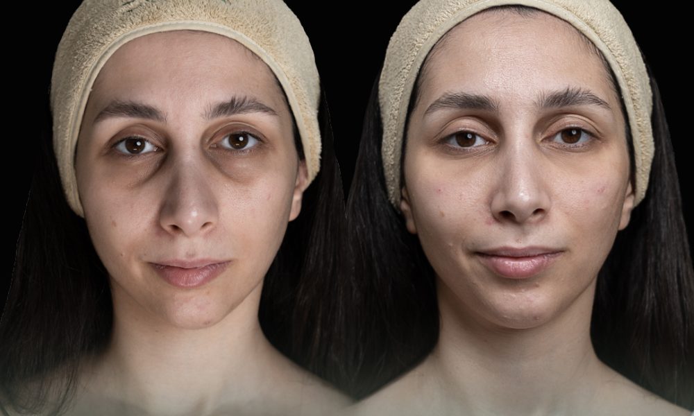 before and after eecla 11 copy layla